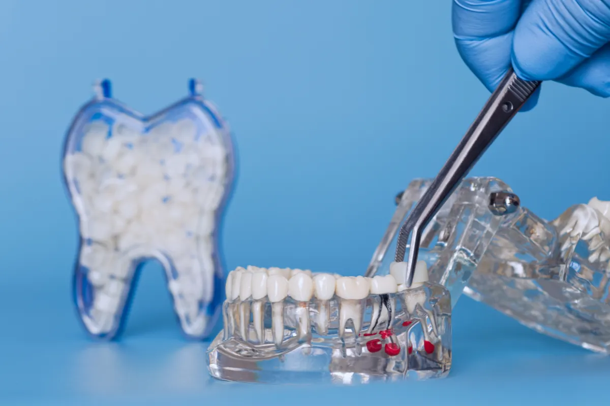 Cost of Dental Crowns in Barrhaven