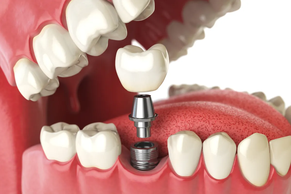 What Are Dental Implants