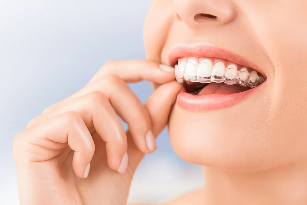 Invisalign Treatment Process
